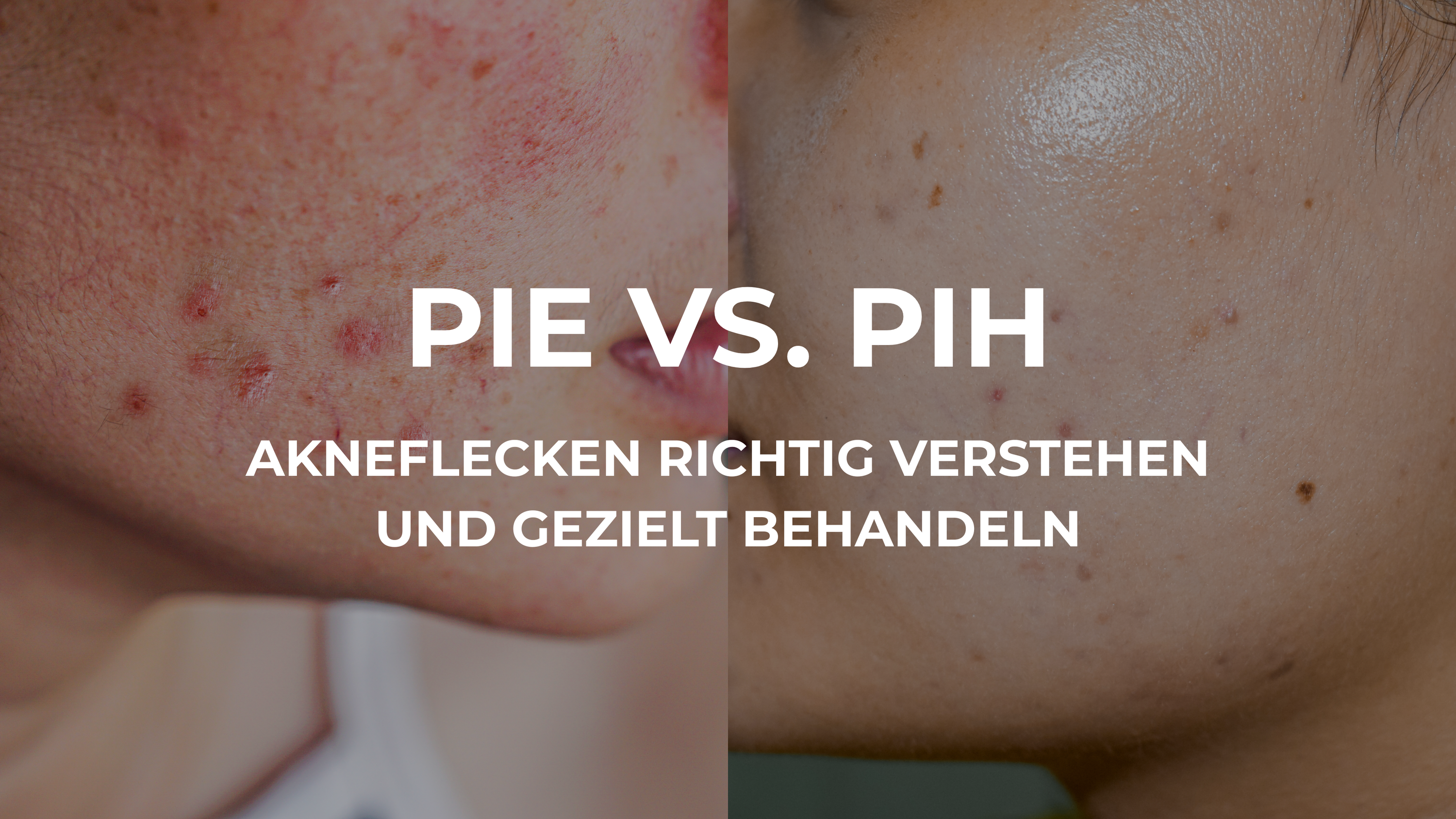 PIE und PIH – warum Akneflecken nicht gleich Akneflecken sind
